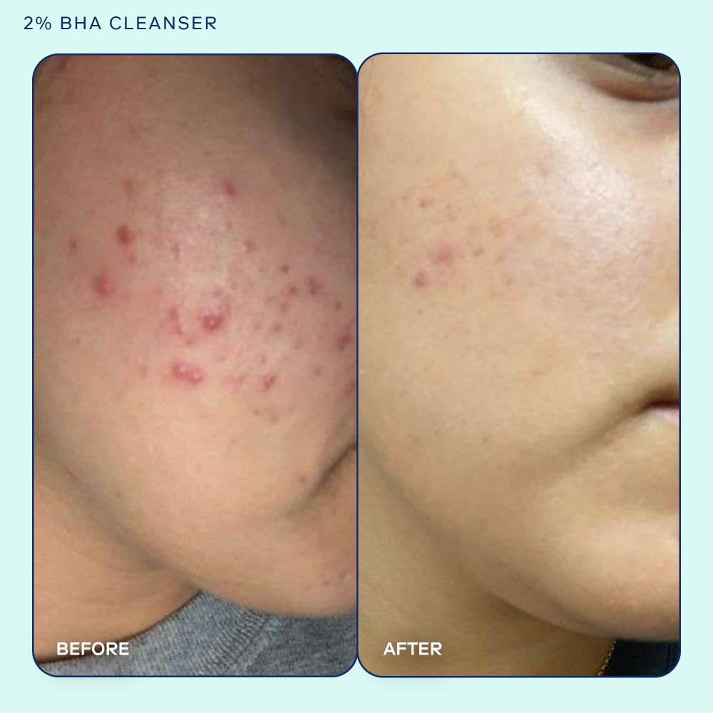 Skinfix Acne+ BHA Cleanser and Acne+ Adapinoid Gel