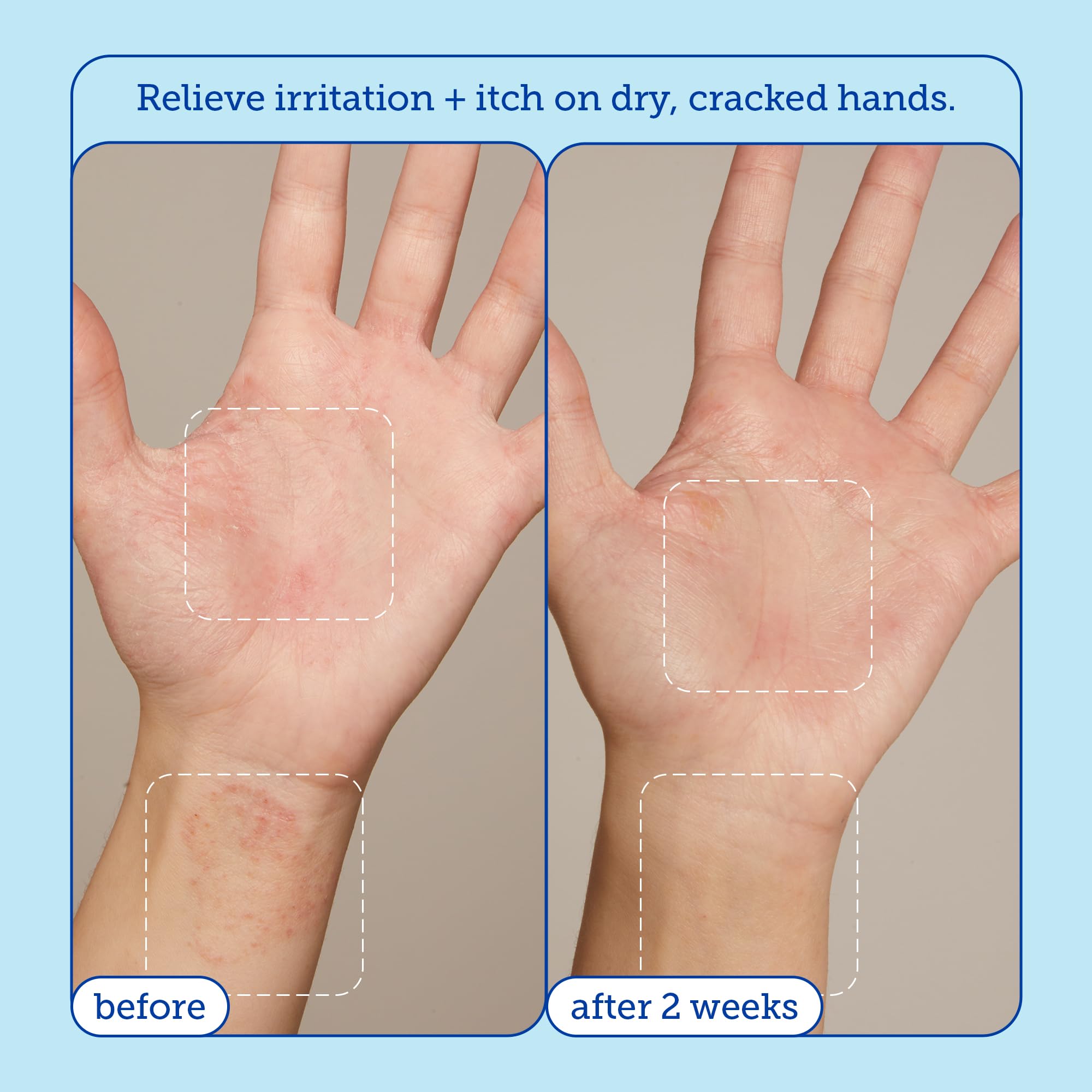 Skinfix Eczema+ Hand Relief Cream