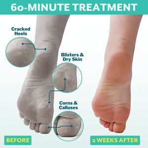 Patchology PoshPeel Pedi Cure - Foot Peel Mask Soak Treatment