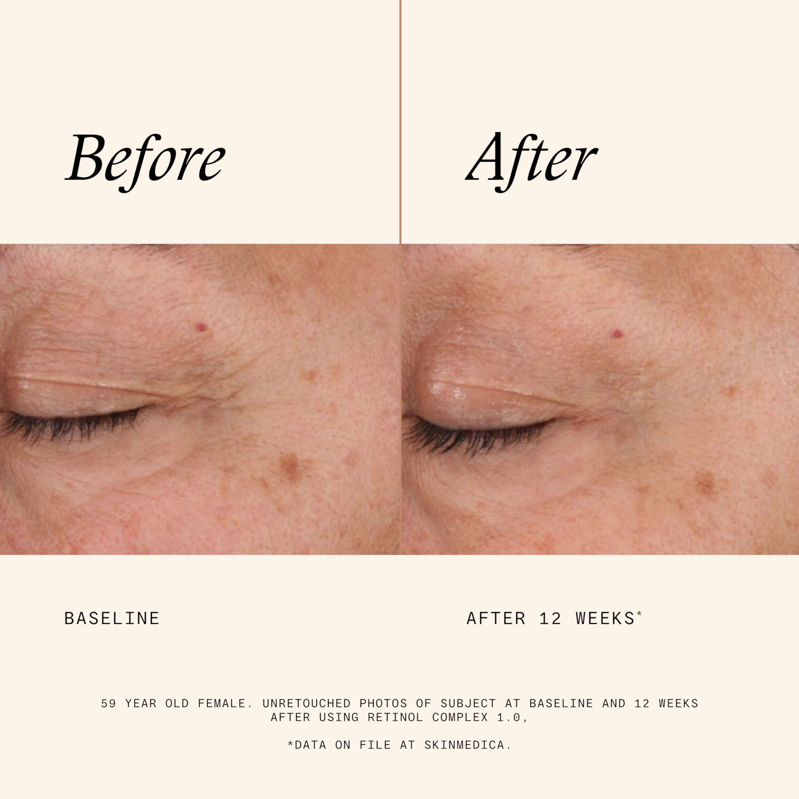 SkinMedica Retinol 1.0 Complex - Retinol Serum