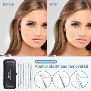 JPNK Blackhead Remover Tool Comedones Extractor Acne Removal Kit