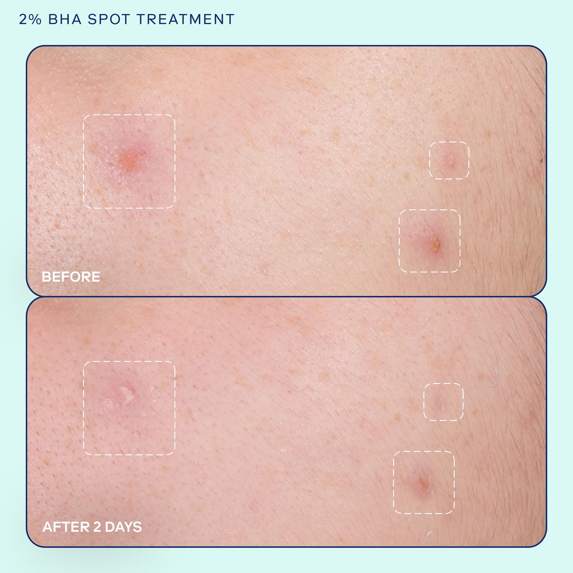 Skinfix Acne+ 2% BHA Acne Spot Treatment