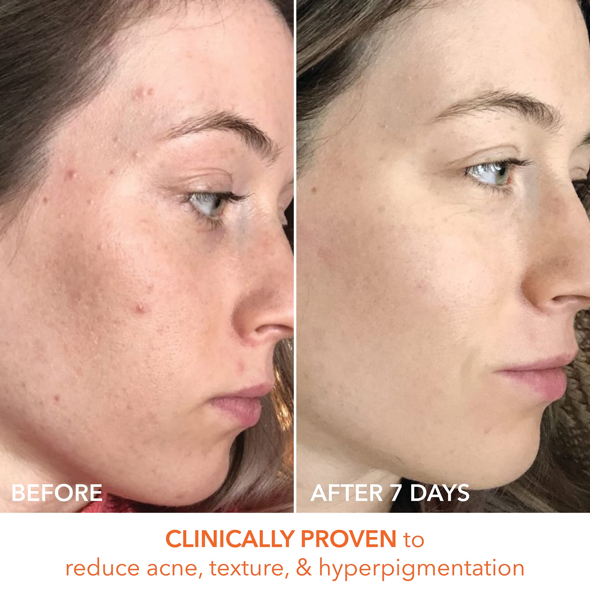 Dr Dennis Gross Alpha Beta Universal Daily Peel