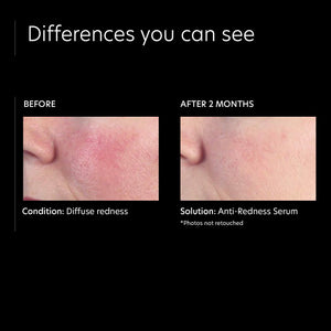 PCA SKIN Anti Redness Remover Face Serum