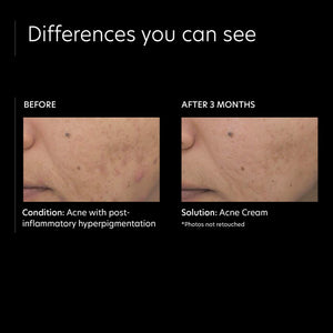 PCA SKIN Acne Treatment Cream for Face