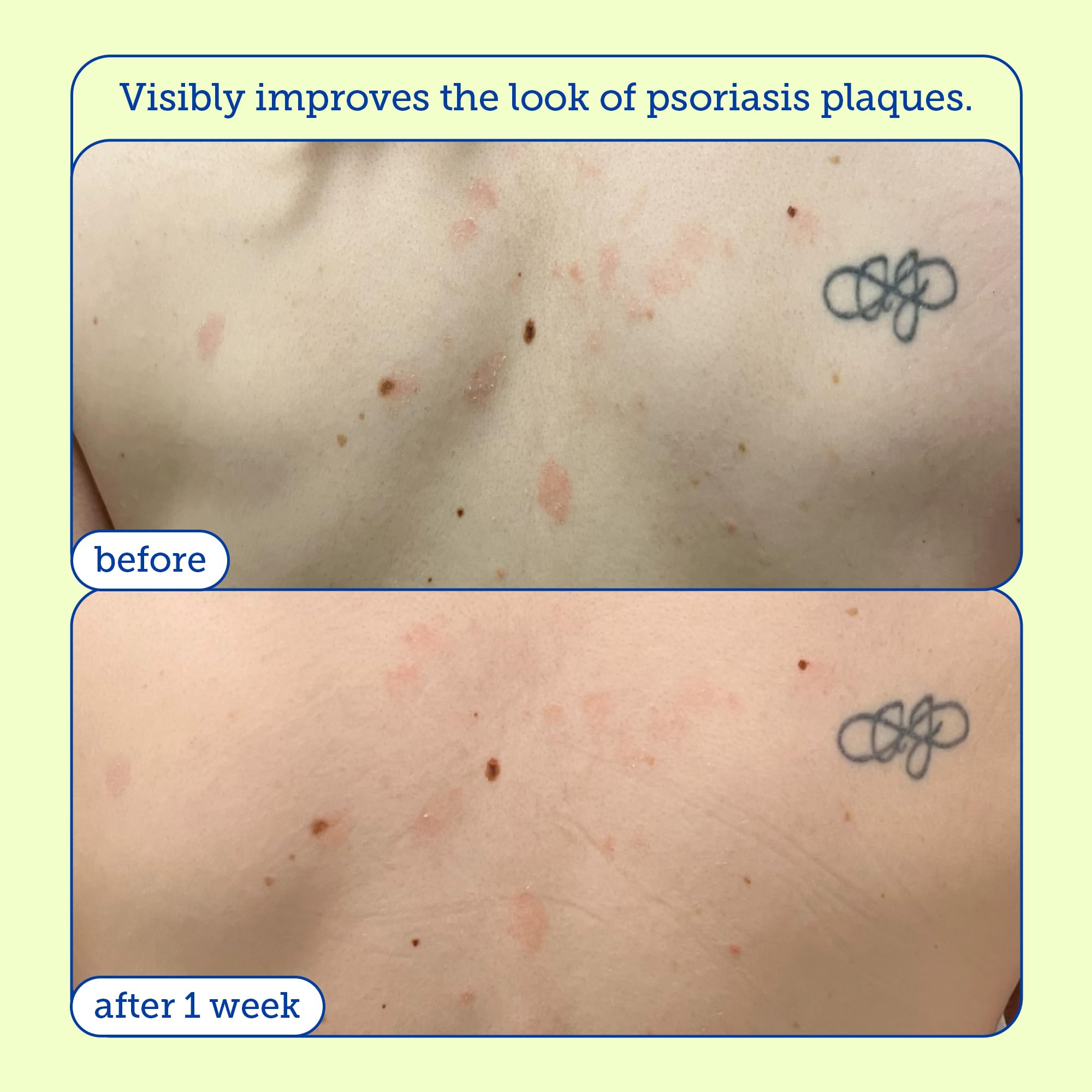 Skinfix KP+ Psoriasis Smoothing Treatment Body Lotion