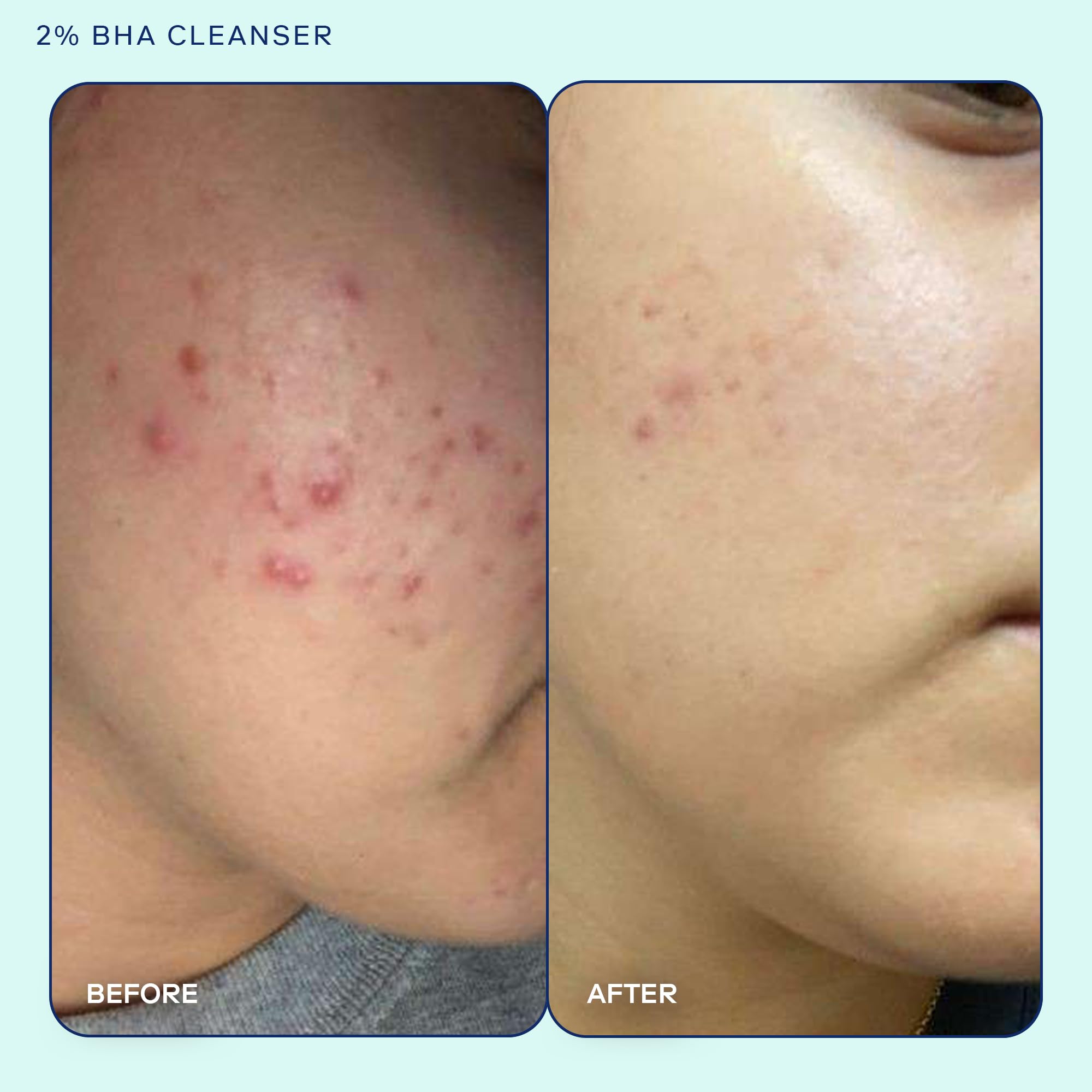 Skinfix Acne+ BHA Cleanser