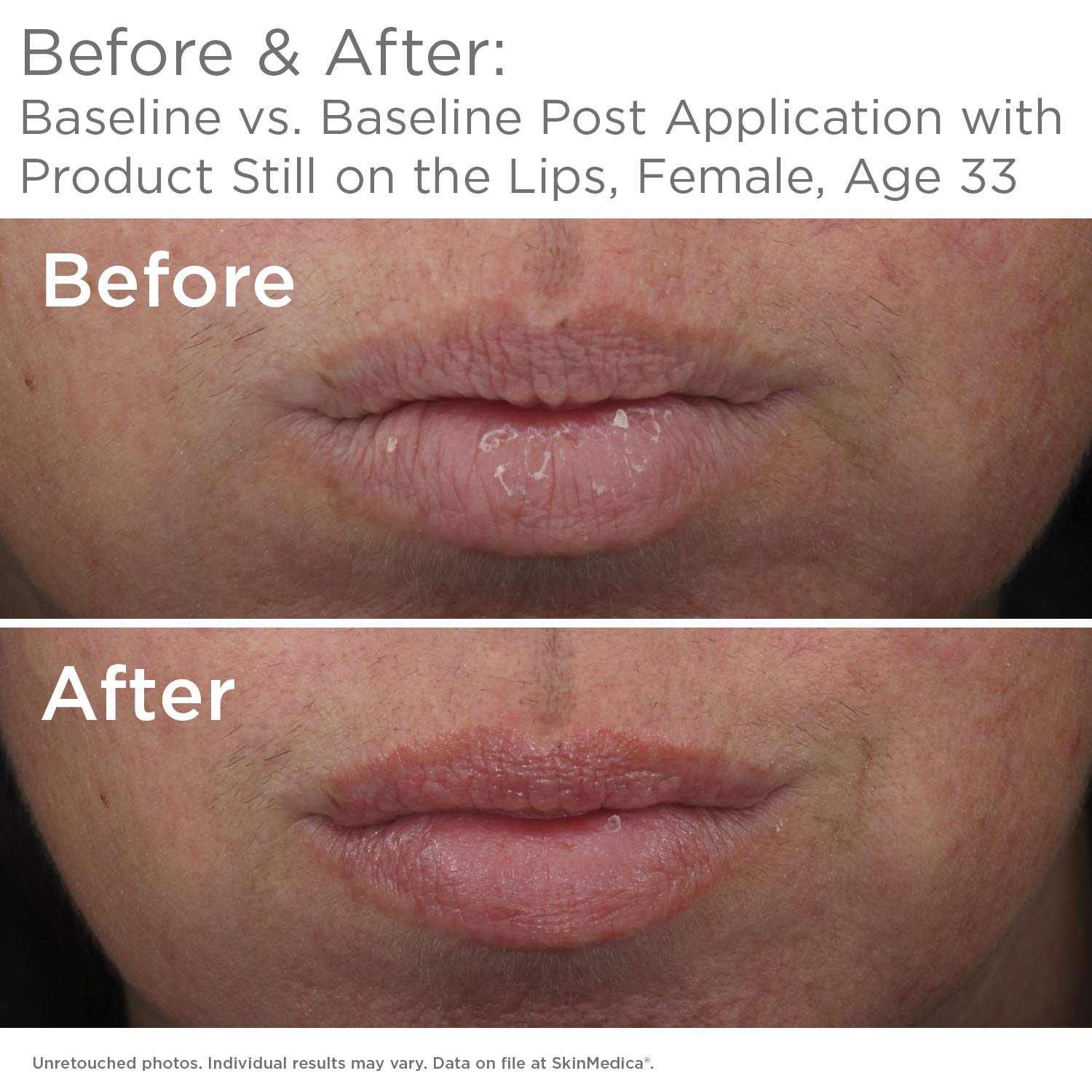 SkinMedica HA5 Smooth & Plump Lip System