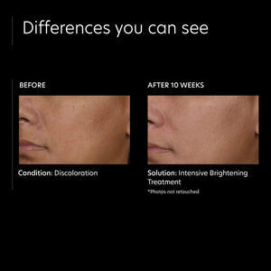 PCA SKIN Intensive Brightening Treatment