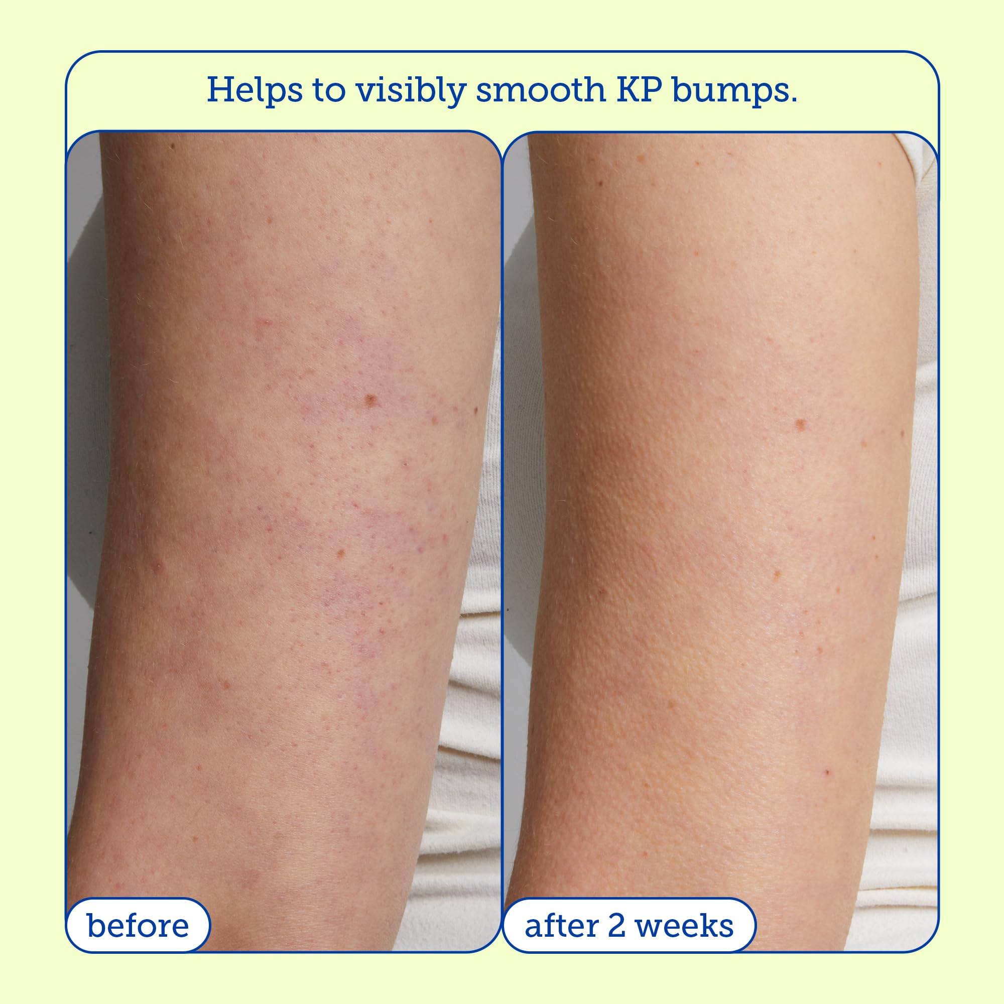 Skinfix KP+ Psoriasis Smoothing Treatment Body Lotion