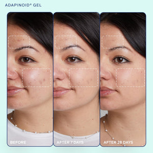 Skinfix Acne+ Adapinoid® Gel