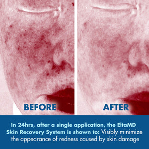 EltaMD Skin Recovery System Facial Skin Care Set